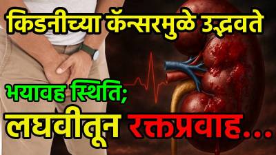 किडनीच्या कॅन्सरमुळे उद्भवते भयावह स्थिति; लघवीतून रक्तप्रवाह…
