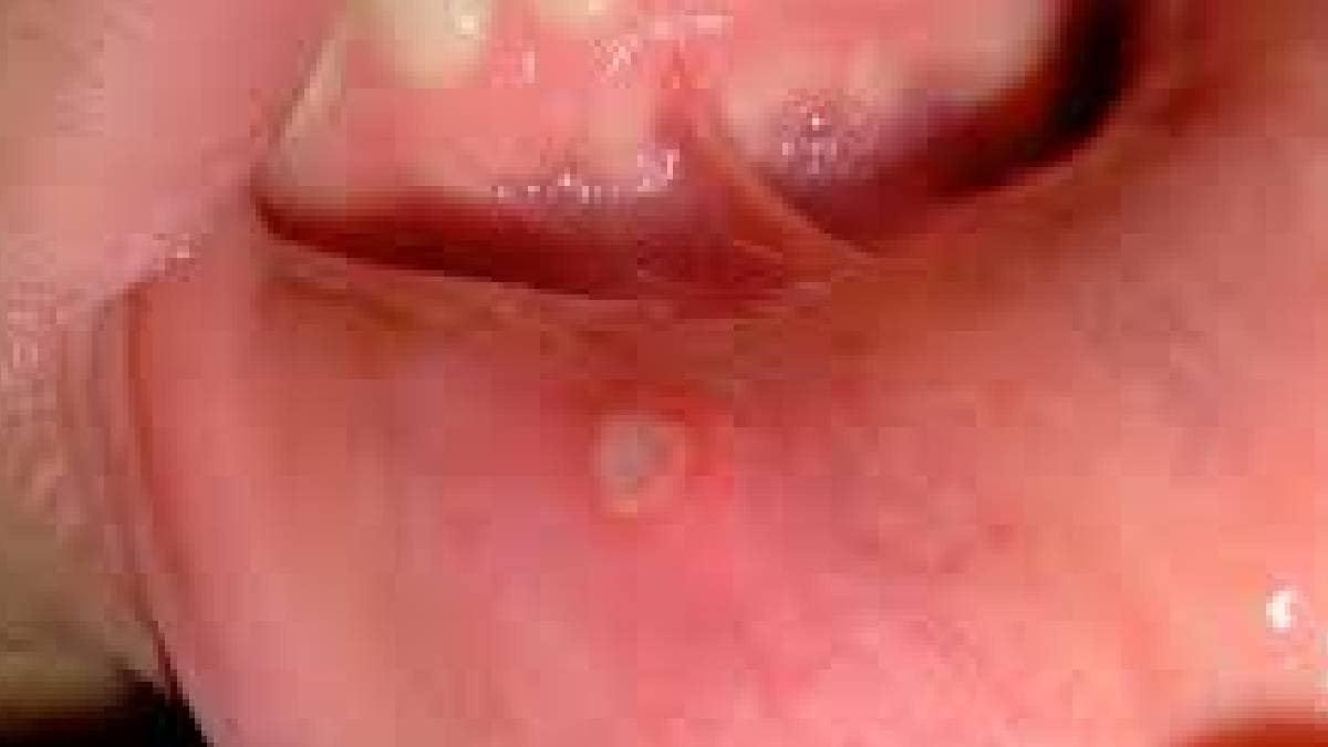 Mouth ulcers painful,