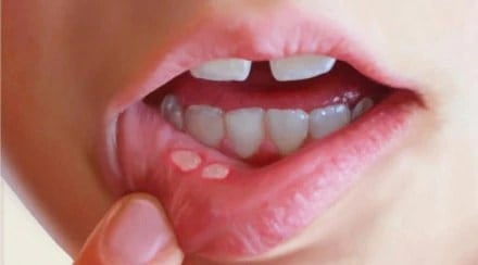 Mouth ulcers painful,
