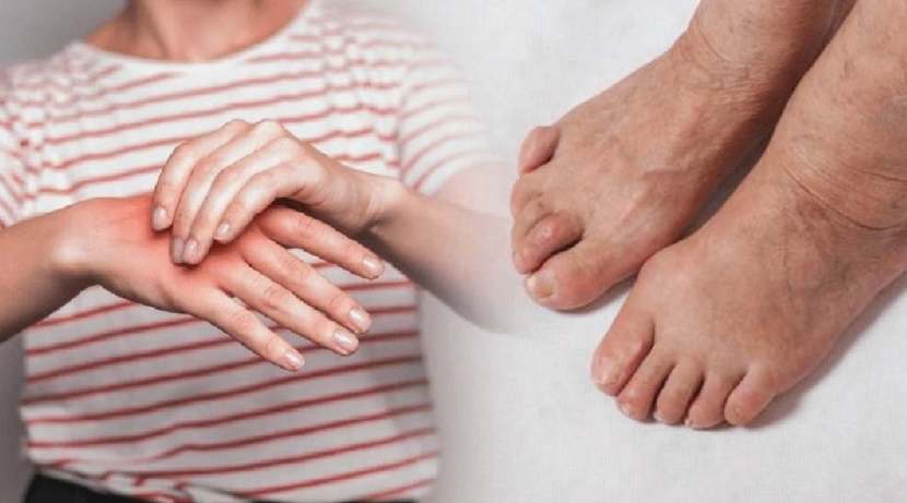 Serious signs of uric acid are also visible on the skin 
