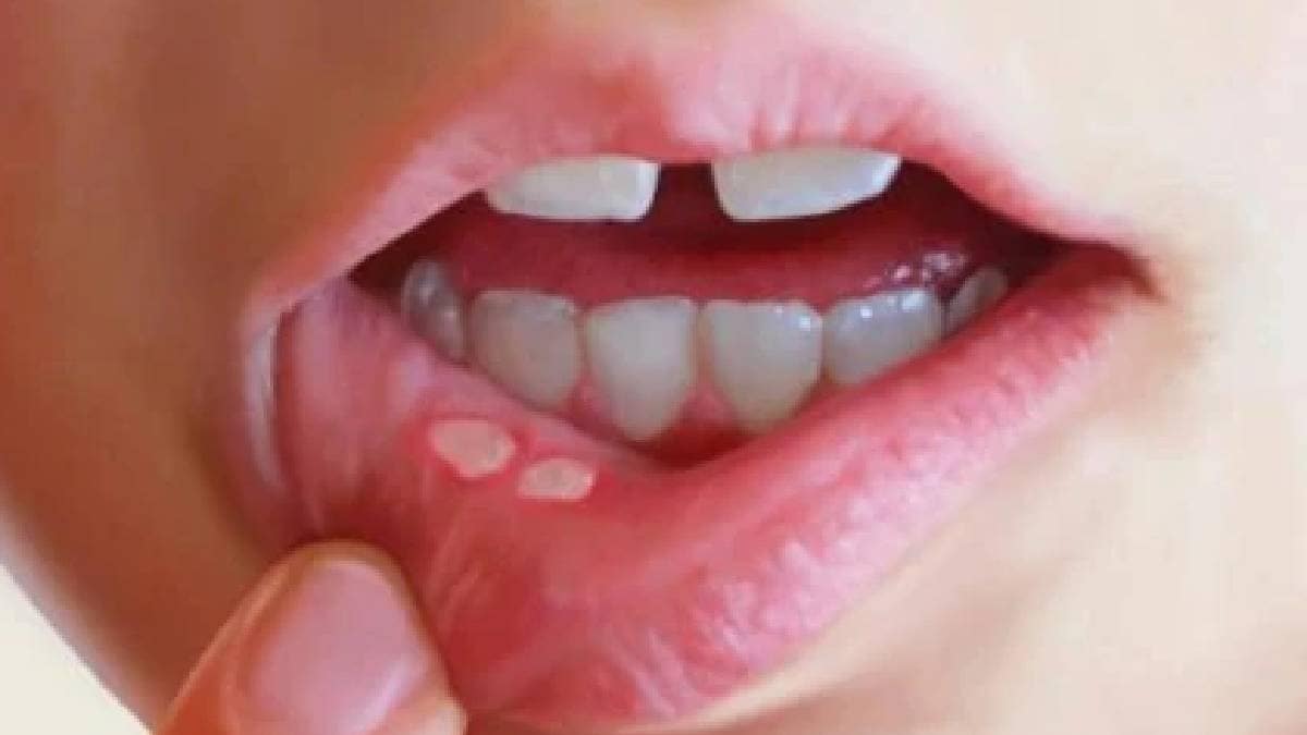Mouth ulcers