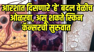 Skin Cancer Early Signs