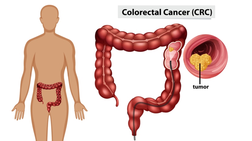 colon cancer symptoms causes and treatment