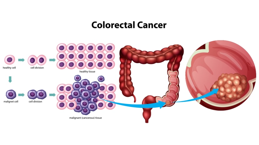 colon cancer symptoms in young people adults fruits for colon cancer