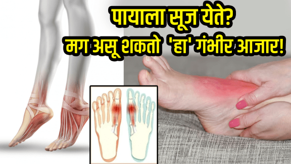 Foot problems swollen foot symptoms of serious disease like heart and Diabetes peripheral artery disease