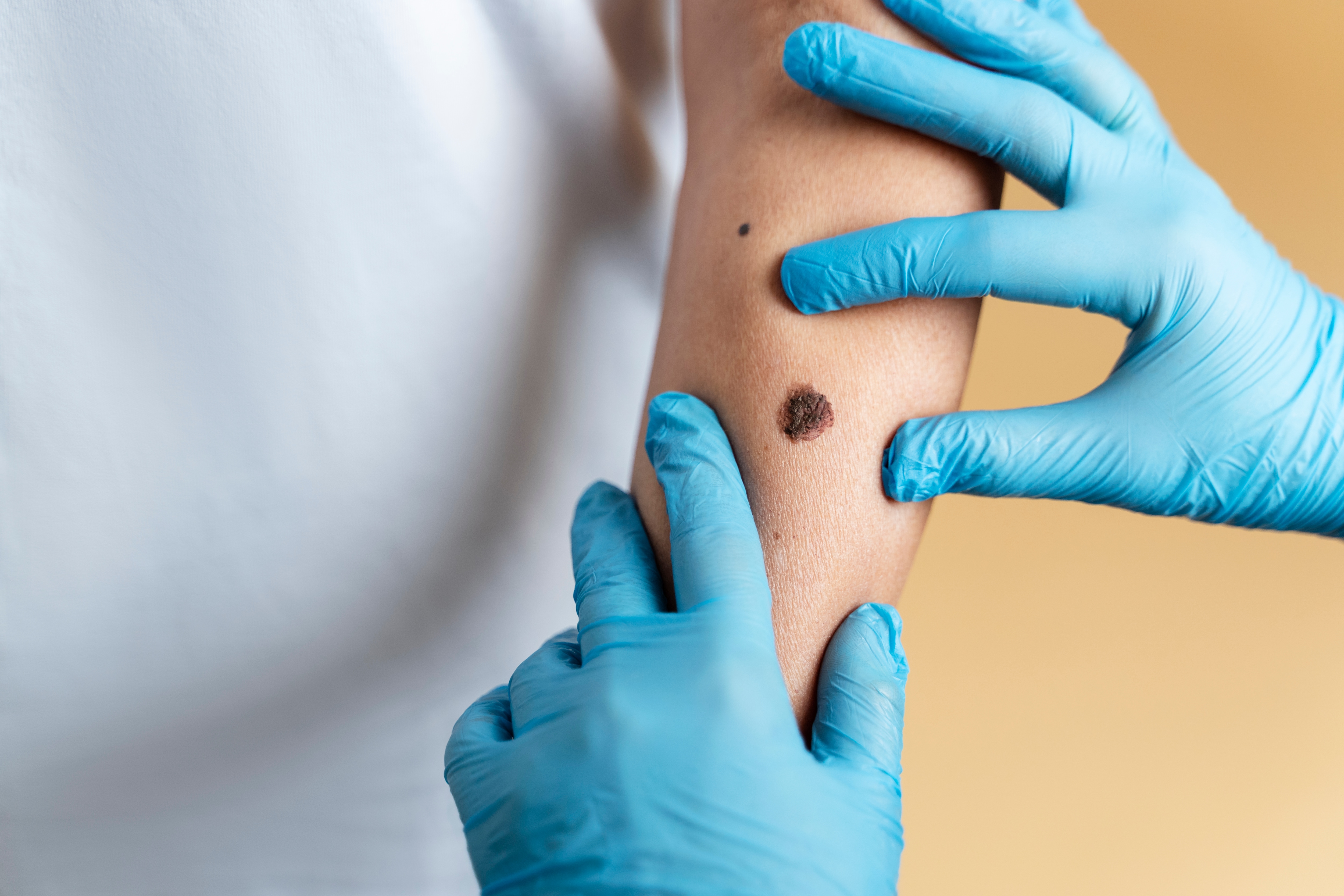 vitamin B3 supplements for skin cancer
