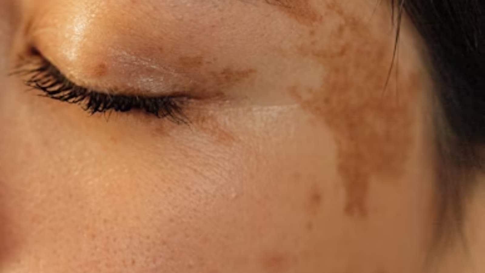 health, skin