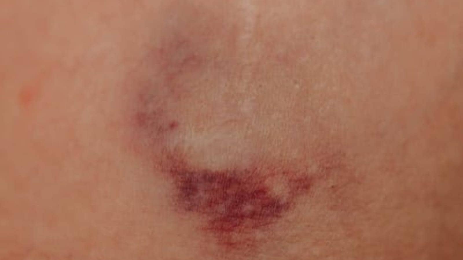 health, swelling