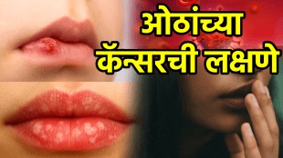 lip cancer symptoms sun exposure cause lip cancer early signs prevention tips photos doctor advice