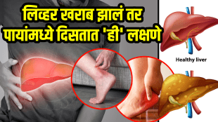 Liver health signs liver damage symptoms on feet and legs liver failure
