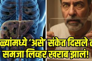Liver Cirrhosis Symptoms