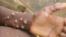 First Monkeypox Case In Maharashtra : धुळ्यात मंकीपॉक्सचा महाराष्ट्रातील पहिला रुग्ण
