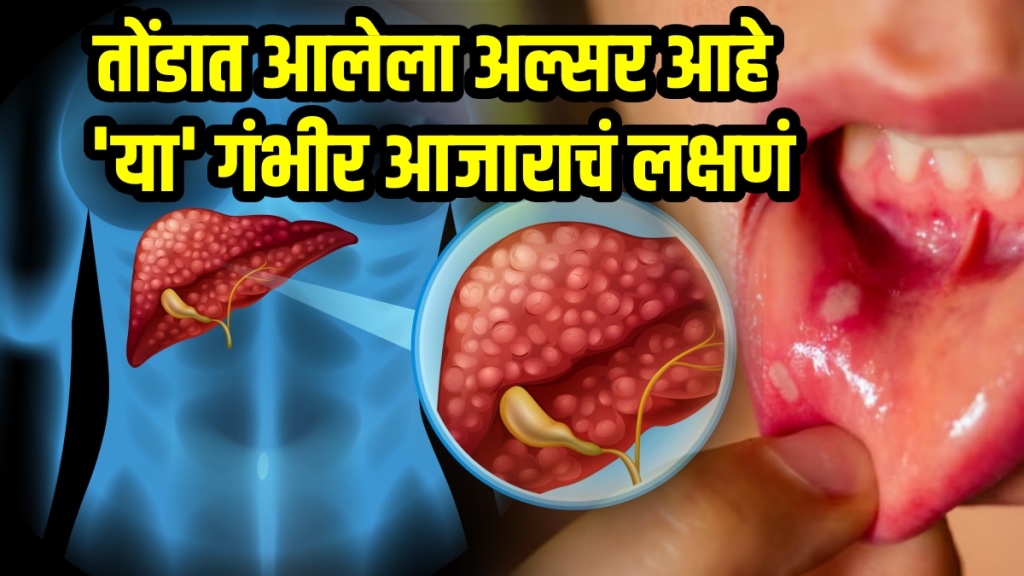 Mouth ulcers reason liver heat how to treat mouth ulcer with home remedies ayurvedic ulcers in mouth Mouth ulcers reason liver heat how to treat mouth ulcer with home remedies ayurvedic ulcers in mouth