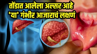 Mouth ulcers reason liver heat how to treat mouth ulcer with home remedies ayurvedic ulcers in mouth