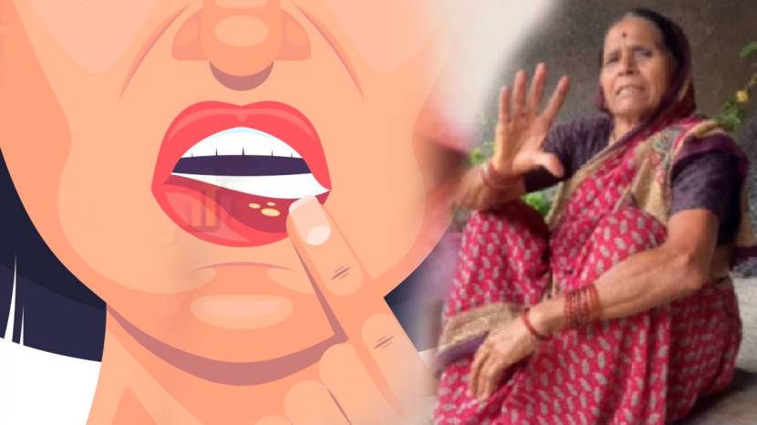 mouth-ulcers-remedies 