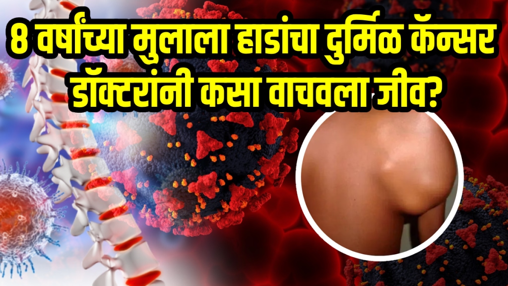 8 year old boy fought with Rare cancer bones ewings sarcoma doctor explained treatment 8 year old boy fought with Rare cancer bones ewings sarcoma doctor explained treatment