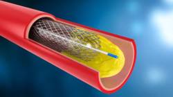 भारतीय बनावटीचा ‘स्टेंट’ अमेरिकेपेक्षा भारी; जागतिक परिषदेत उपलब्धीचे कौतुक