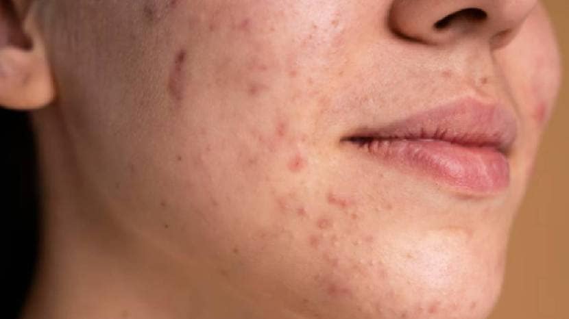 turti-benefits-of-dark-spots