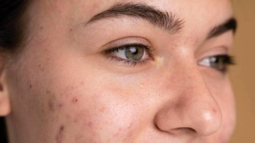 turti-for-your-pimples