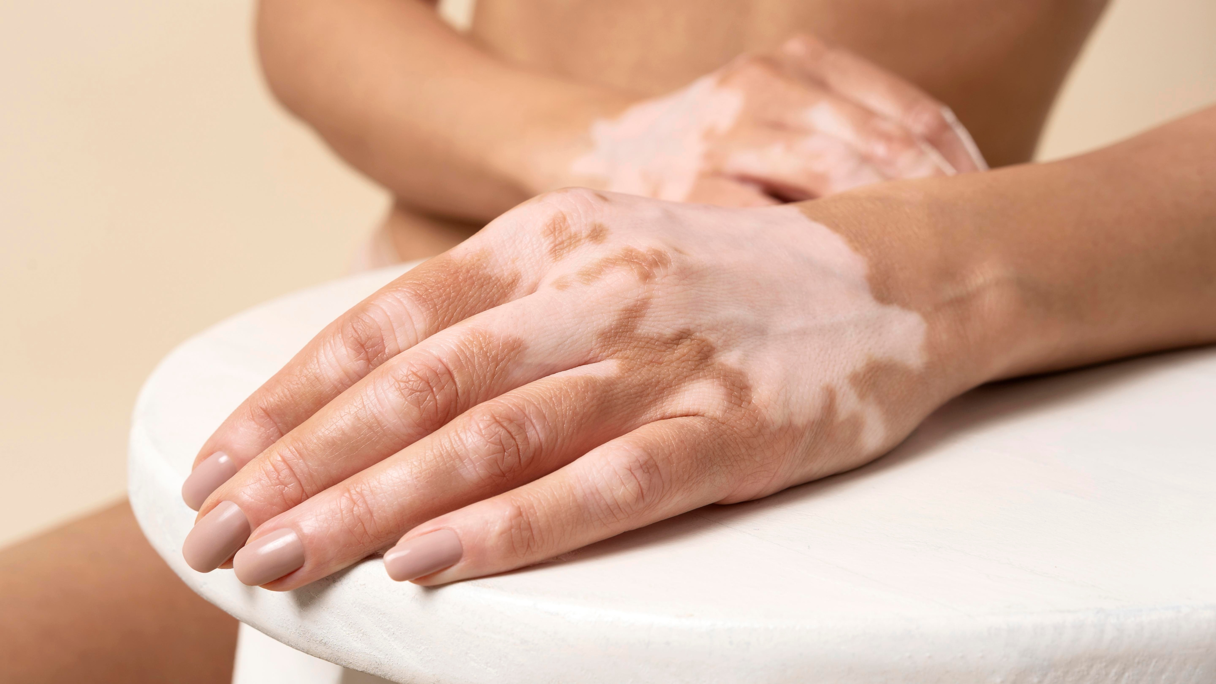 vitamin B3 supplements for skin cancer