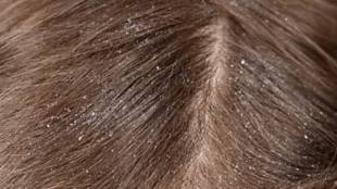Get rid of dandruff