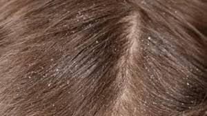 पैसे खर्च न करता ‘या’ ६ घरगुती उपायांनी मिळवा केसांमधील कोंड्यापासून सुटका