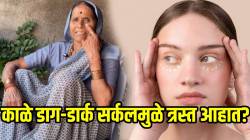 VIDEO: डोळ्यांखालची काळी वर्तुळं कमीच होत नाहीत? मग आजीबाईंनी सांगितलेले ‘हे’ ५ घरगुती उपाय करून तर बघा