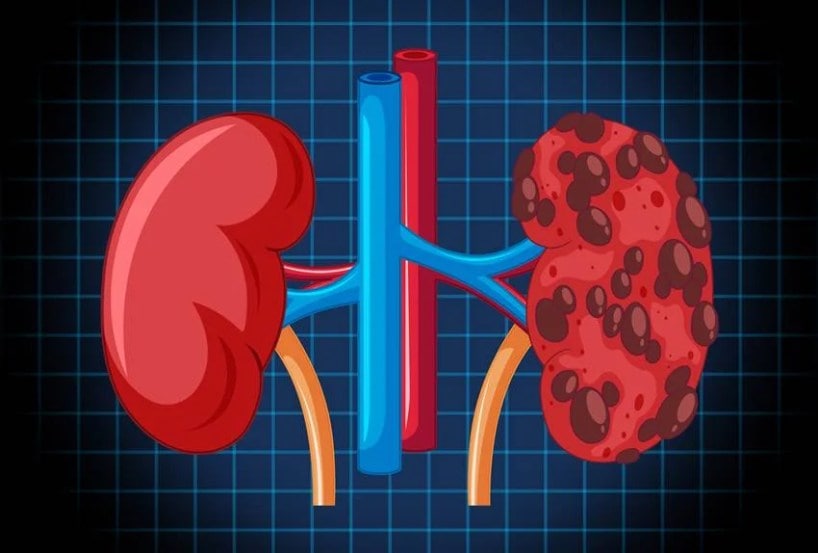 Kidney Damage Habits 