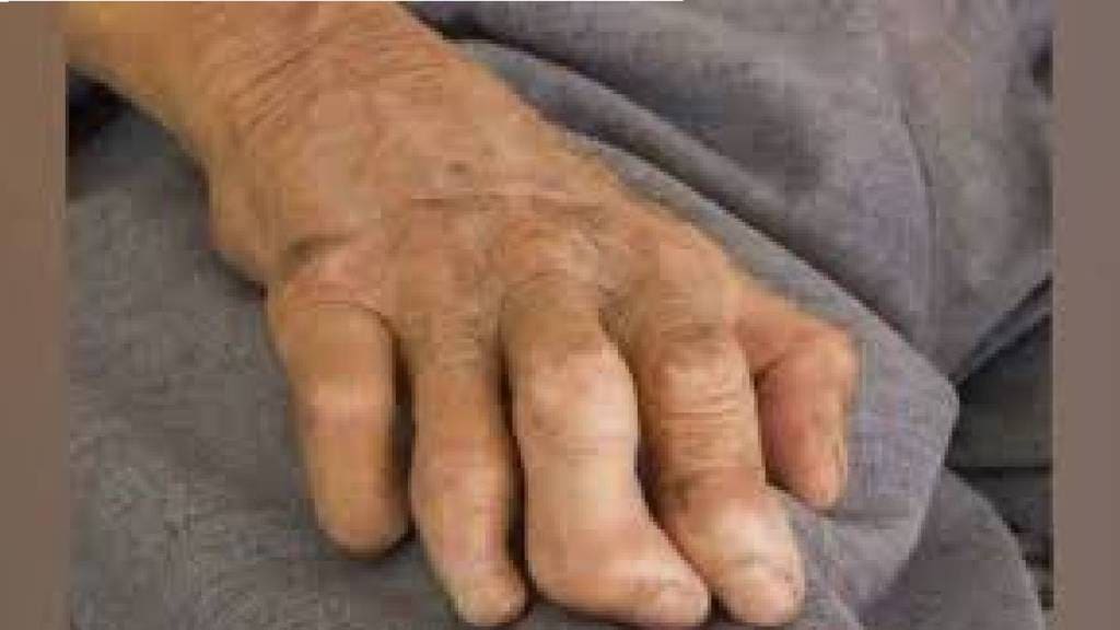 state continues annual leprosy detection campaign