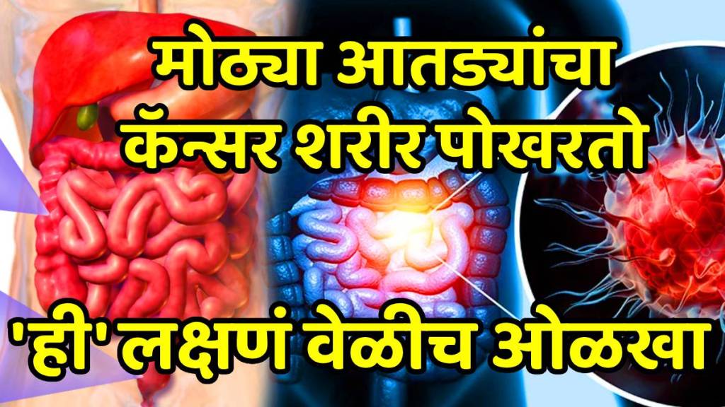 Colon cancer prevention