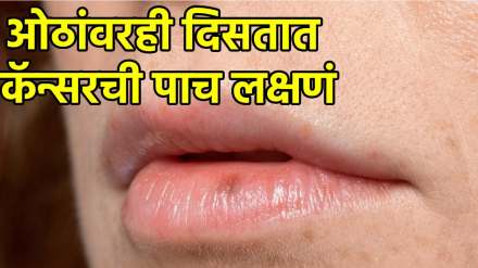 Cancer Symptoms On Lips Cancer Symptoms On Lips