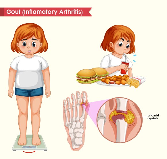 Ayurvadic remedies for uric acid