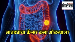 Colon Cancer : विष्ठेतून कसा ओळखाल आतड्याचा कॅन्सर? ‘ही’ लक्षणे दिसताच वेळीच सतर्क व्हा! तज्ज्ञांचा इशारा काय?