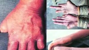 dhule health department arrange leprosy survey