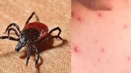 65 year old farmer dies of scrub typhus Amravati news 65 year old farmer dies of scrub typhus Amravati news