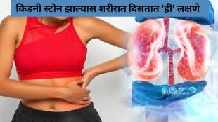 Prevent Recurring kidney Stones