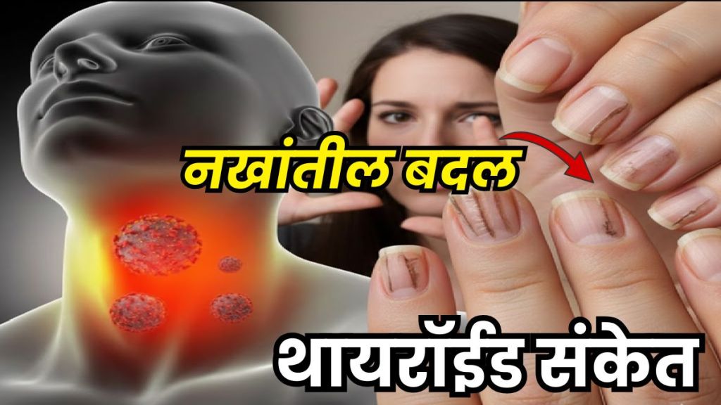 5 Nail Changes Linked to Early Thyroid Disorders 5 Nail Changes Linked to Early Thyroid Disorders