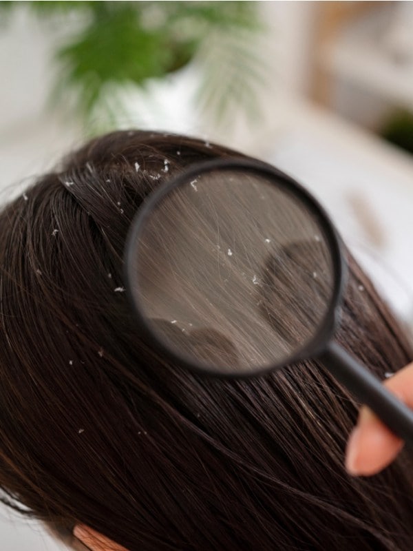 Winter Dandruff Home Remedies