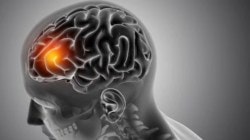 देशी बनावटीचे ‘सुपरनोव्हा’ स्ट्रोक उपकरण मंजूर! ब्रेन स्ट्रोक रुग्णांसाठी आशेचा नवा किरण…