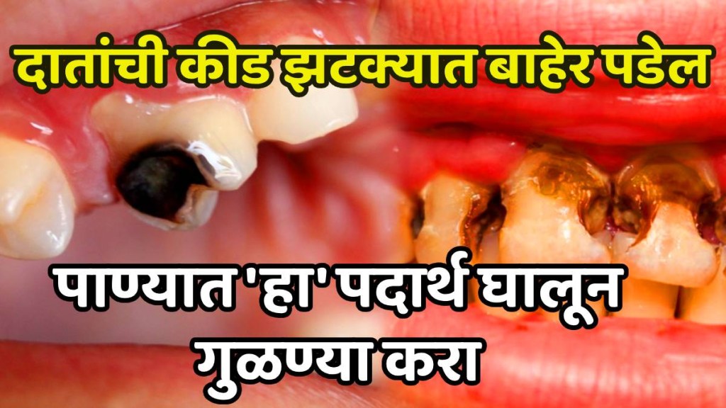 Natural ways to remove tooth cavity and strengthen teeth How To Get Rid Of Teeth Cavity Natural ways to remove tooth cavity and strengthen teeth How To Get Rid Of Teeth Cavity