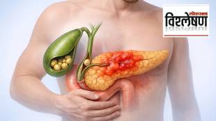 Gallstone Pancreatitis