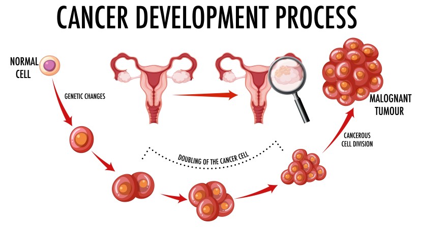 Cervical Cancer
