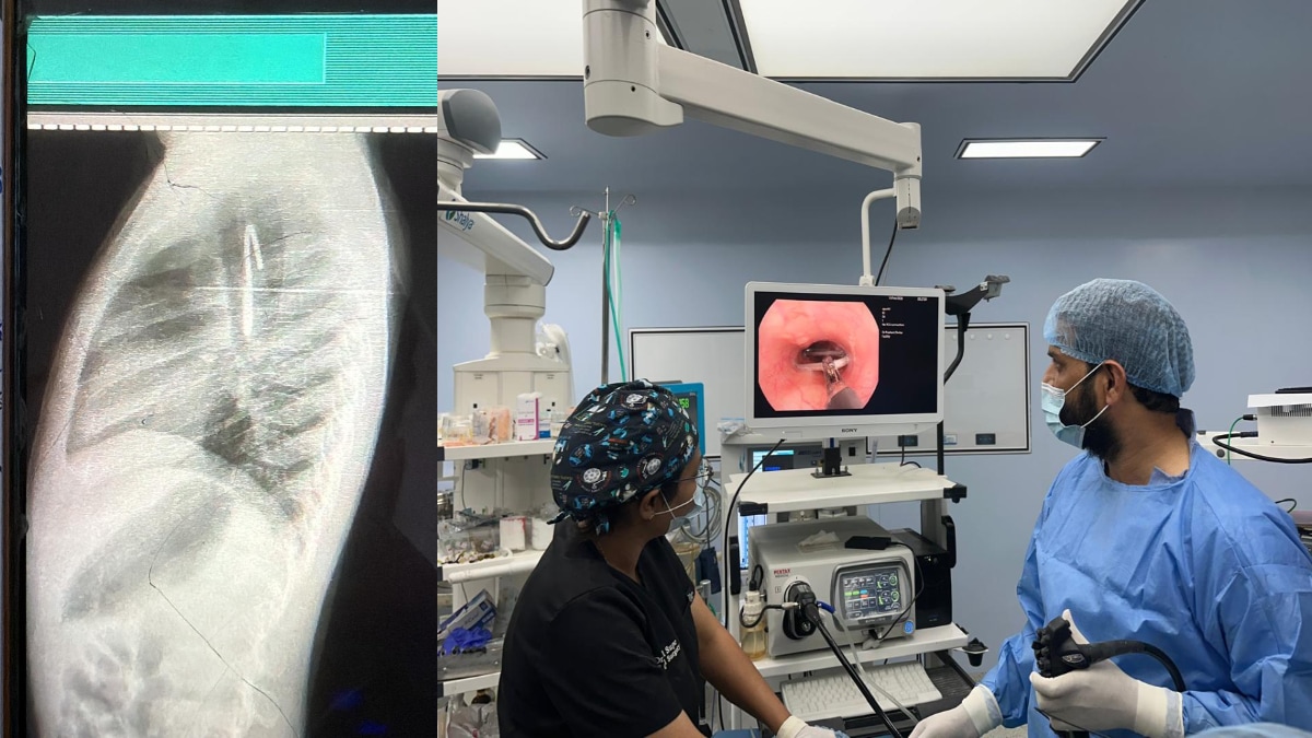 sangli miraj government civil hospital complex surgery girl life saved doctors