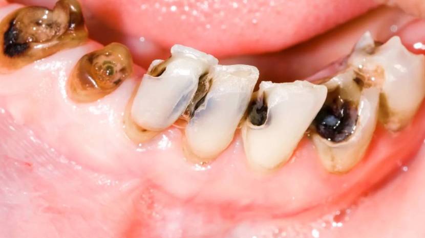 Teeth Whitening home remedy and how to remove bacteria from teeth easily healthy teeth tips