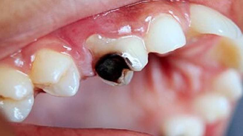 Teeth Whitening home remedy and how to remove bacteria from teeth easily healthy teeth tips