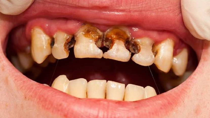 Teeth Whitening home remedy and how to remove bacteria from teeth easily healthy teeth tips