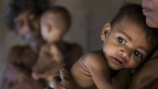 Tribal Child Malnutrition Maharashtra | National Protein Day 2026 | महाराष्ट्र कुपोषण आदिवासी मुले | नॅशनल प्रोटीन डे