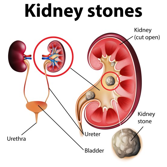 Kidney stone symptoms and UTI prevention tips