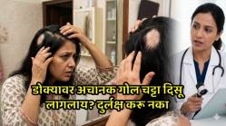 अचानक होणारी केसगळती आणि टाळूवरचे चट्टे; ‘एलोपेसिया’ आजाराची लक्षणे, तज्ज्ञ काय सांगतात?