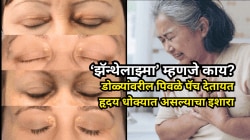 डोळ्यांवरील पिवळे पॅच देतायत हृदय धोक्यात असल्याचा इशारा; ‘झॅन्थेलाझ्मा’ म्हणजे काय, तज्ज्ञ सांगतात